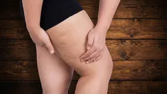 Where Does Cellulite Come From, and Can You Really Get Rid of It?