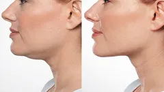 The best exercises to get rid of a double chin without surgery.